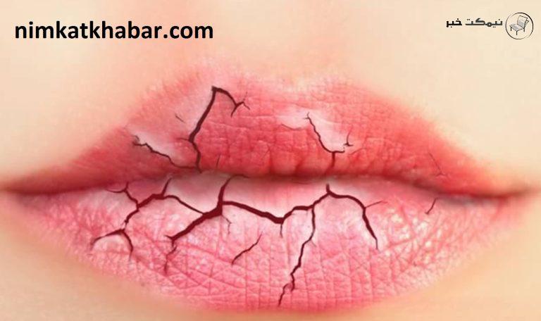 داشتن لب های سالم و لطیف و جلوگیری از خشکی و ترک لب