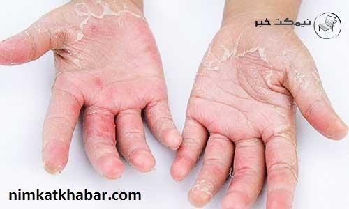درمان اگزمای پوست و حساسیت و جلوگیری از بروز آنها 