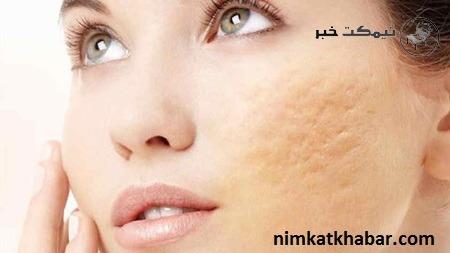درمان جای جوش صورت و بدن با استفاده از روش های طبیعی