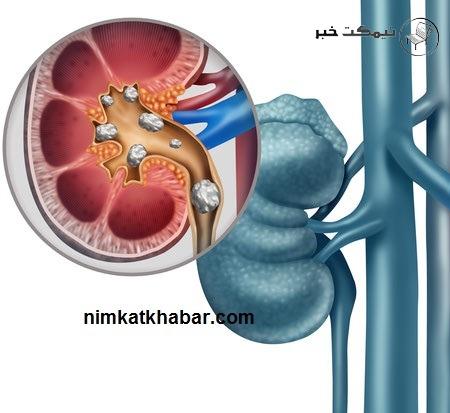 درمان سنگ کلیه با گیاهان دارویی و بدون نیاز به داروهای شیمیایی و مضر