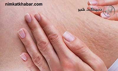 کمرنگ کردن ترک های پوستی با استفاده از مواد طبیعی و بی ضرر