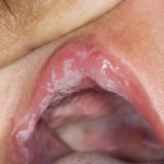 تب برفکی چیست ؟ آیا انسان به تب برفکی مبتلا می شود ؟