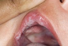 تب برفکی چیست ؟ آیا انسان به تب برفکی مبتلا می شود ؟ تب برفکی در انسان ها