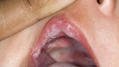 تب برفکی چیست ؟ آیا انسان به تب برفکی مبتلا می شود ؟ تب برفکی در انسان ها