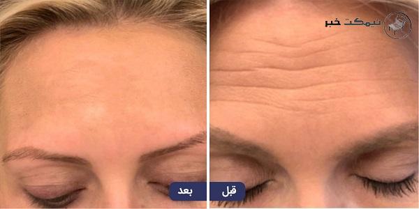 فرق بوتاکس و فیلر 