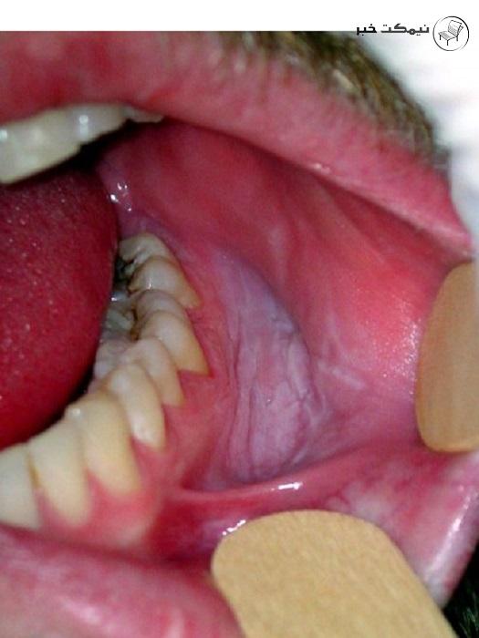 علائم سرطان دهان