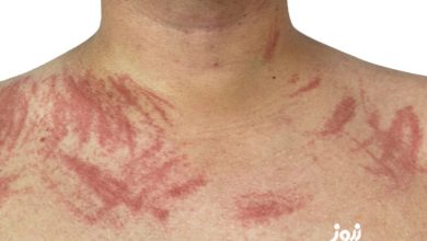 چه علائمی بر روی پوست نشان دهنده بیماری کلیوی است ؟ علائم بیماری کلیه