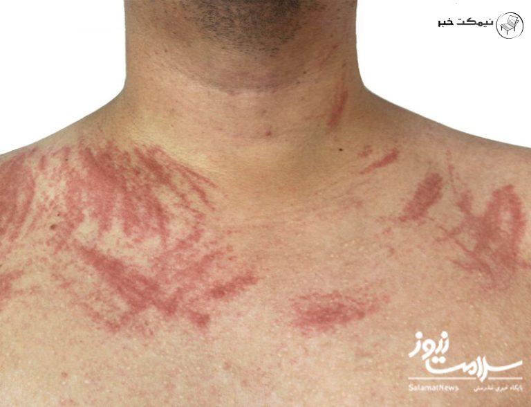 چه علائمی بر روی پوست نشان دهنده بیماری کلیوی است ؟