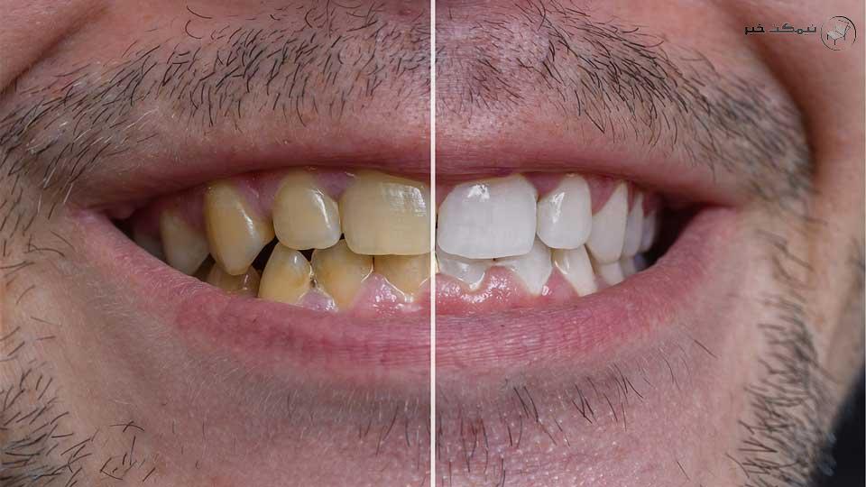 اشتباه رایج موجب دندان زرد 