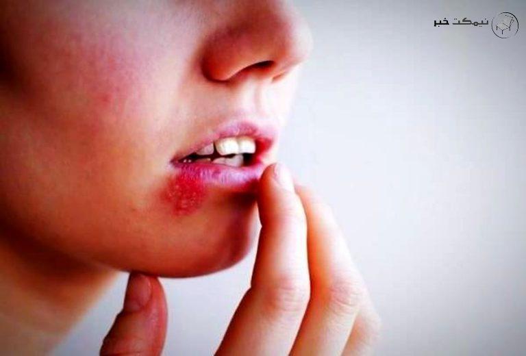 چند خوراکی مناسب برای جلوگیری از ویروس تبخال