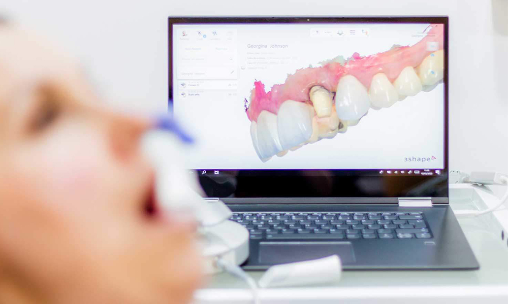 اسکنر داخل دهانی (Intraoral Scanner) اسکنر داخل دهانی (Intraoral Scanner)