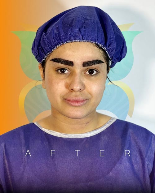 نتیجه کاشت ابروی طبیعی