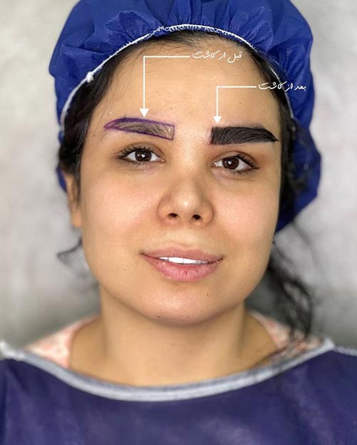 قبل و بعد از کاشت ابرو بدون جراحی