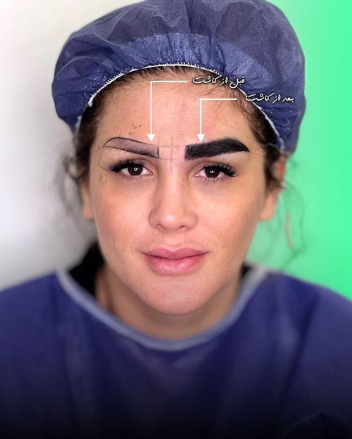 قبل و بعد از کاشت ابرو