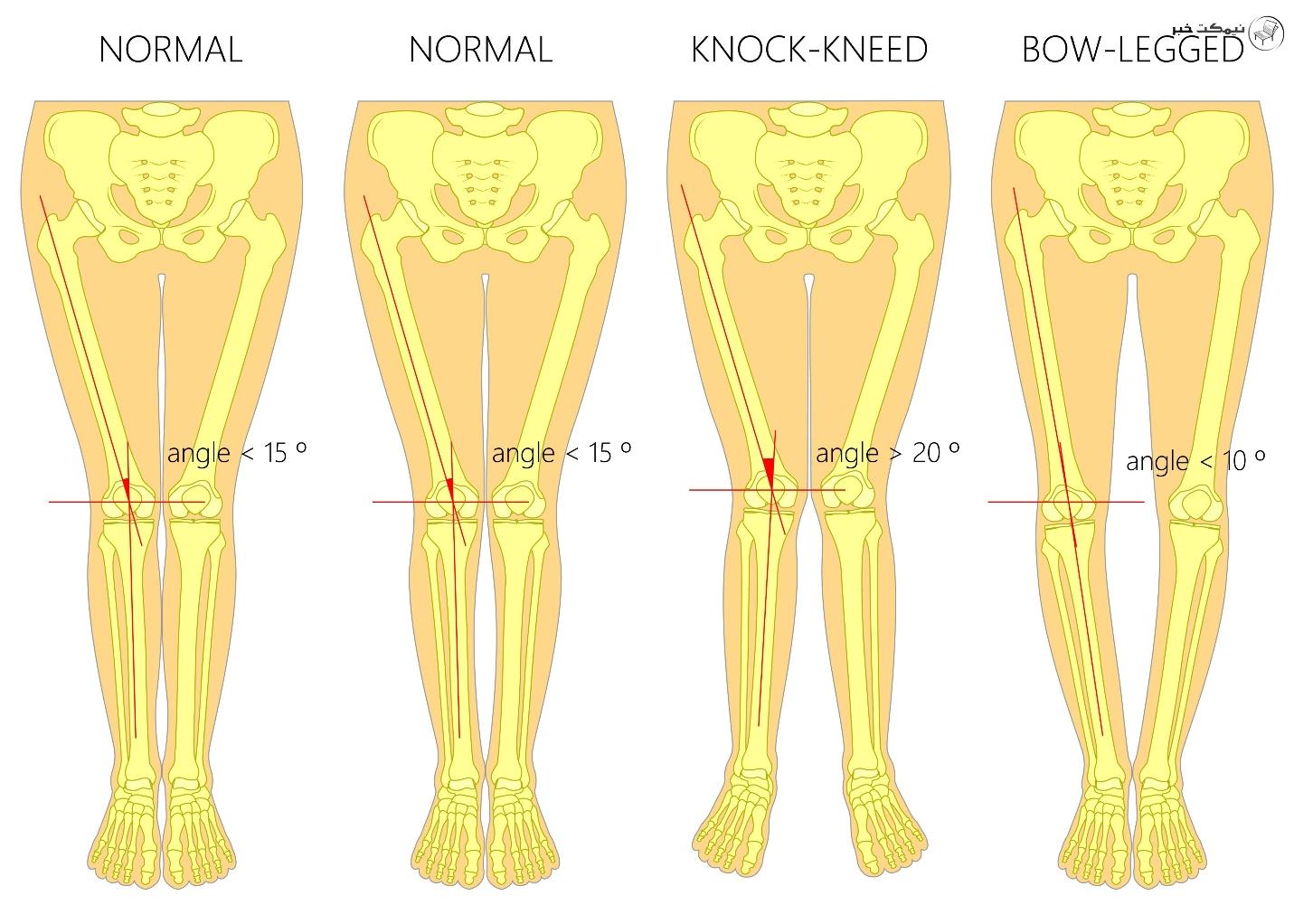 چرا لنگیدن کودک زنگ خطر یک بیماری پنهان است؟